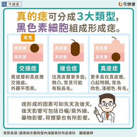 為什麼會長痣|是痣or皮膚癌？醫「1張圖秒對照」 長這2部位最危險